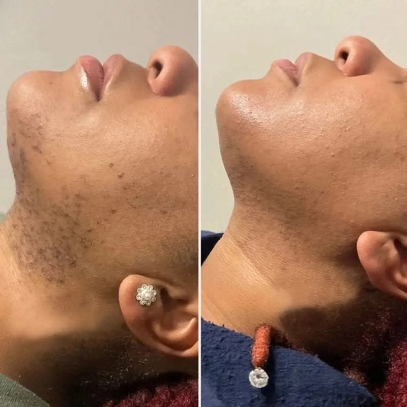 Laser Hair Reduction